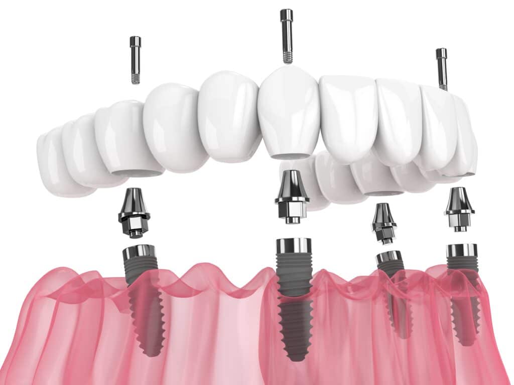 All-on-4 Dental Implants Near Me