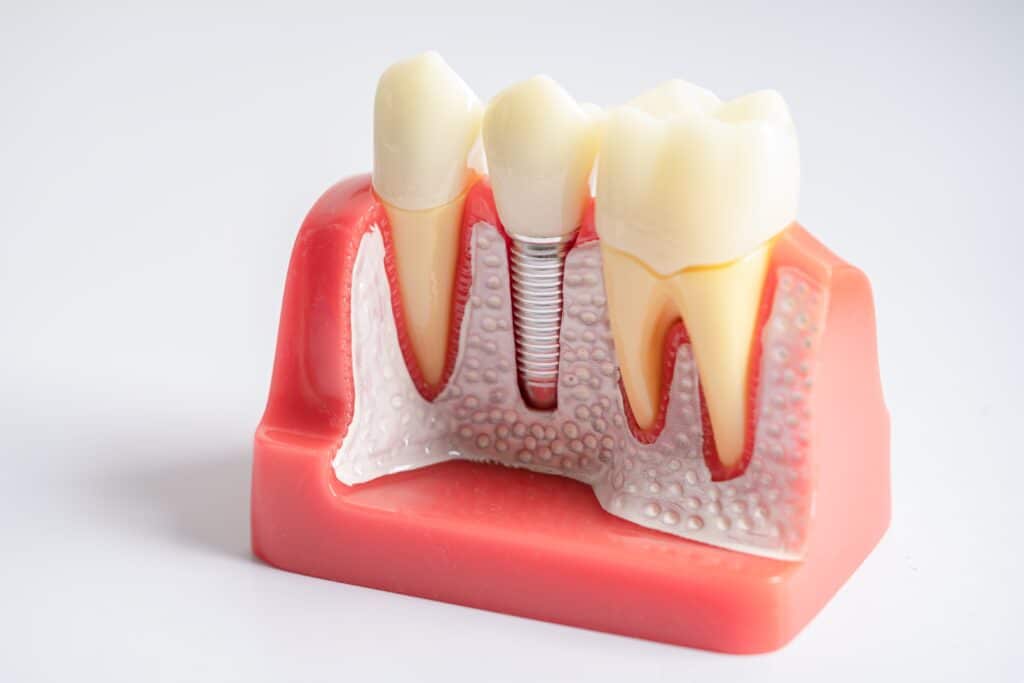 Implant Dentist Lehi