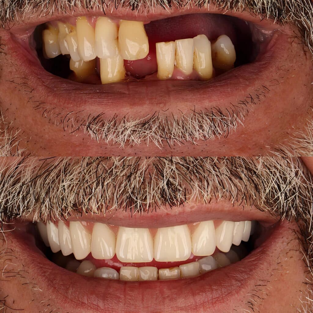 All-on-4 Dental Implants Lehi